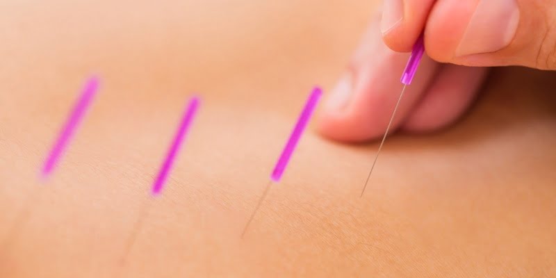 Descubriendo la Acupuntura