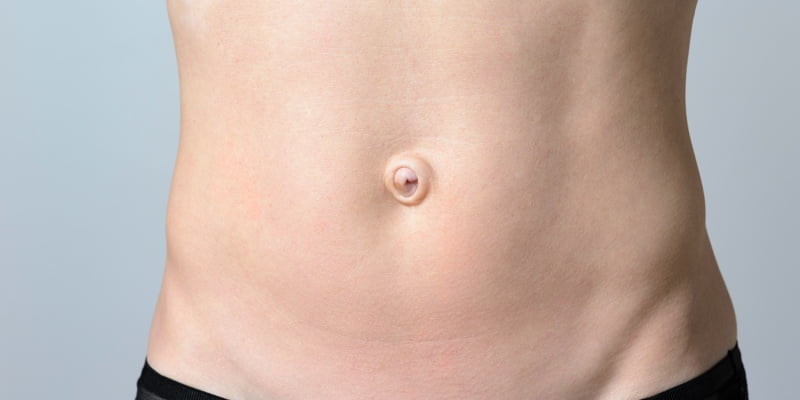 hernia umbilical