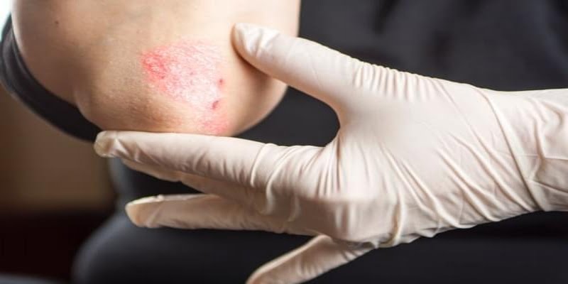 Cómo tratar la psoriasis, ¿tiene cura?