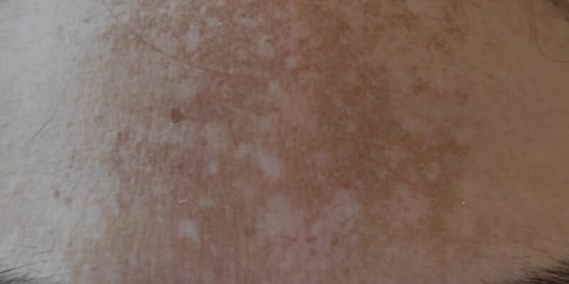 melasma en la piel