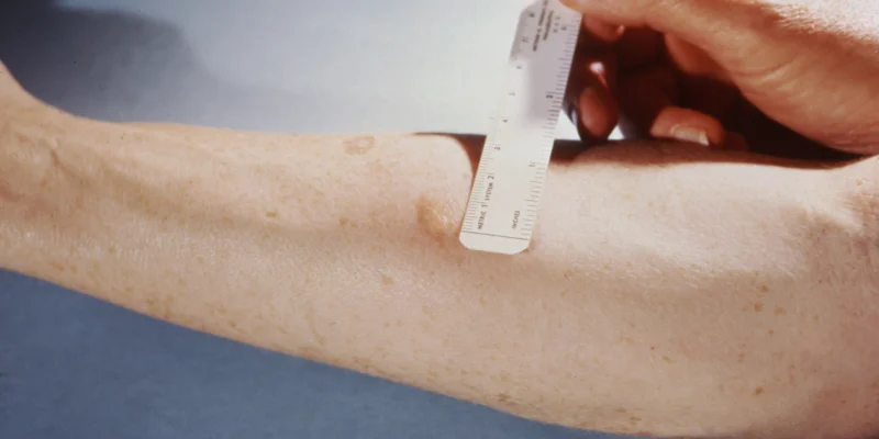 prueba de la tuberculosis en brazo