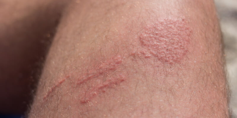 Picaduras De Medusas Como Son Y C mo Tratarlas Blog SaludOnNet