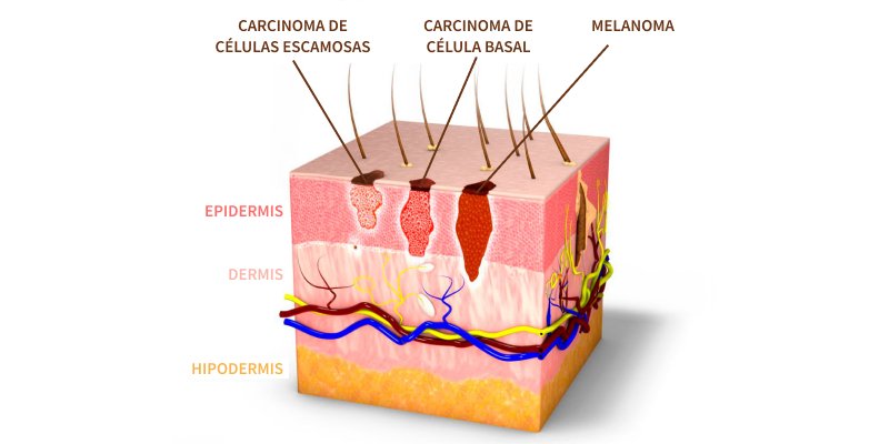 infografía detallada del carcinoma basocelular